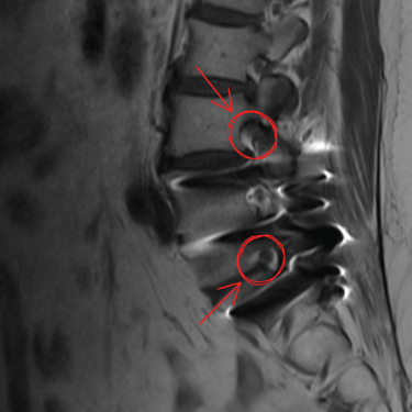 infiltracion lumbar - bloqueo selectivo- lumbalgia- procedimiento intervencionista- dr tafur -neuro-neurocirugia- mejor neuro