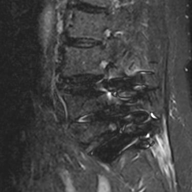 infiltracion lumbar - bloqueo selectivo- lumbalgia- procedimiento intervencionista- dr tafur -neuro-neurocirugia- mejor neuro