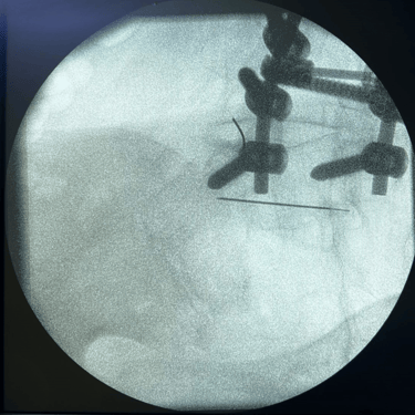 infiltracion lumbar - bloqueo selectivo- lumbalgia- procedimiento intervencionista- dr tafur -neuro-neurocirugia- mejor neuro