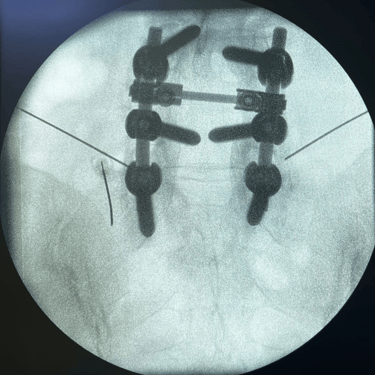 infiltracion lumbar - bloqueo selectivo- lumbalgia- procedimiento intervencionista- dr tafur -neuro-neurocirugia- mejor neuro