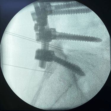 infiltracion lumbar - bloqueo selectivo- lumbalgia- procedimiento intervencionista- dr tafur -neuro-neurocirugia- mejor neuro