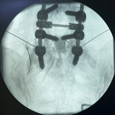 infiltracion lumbar - bloqueo selectivo- lumbalgia- procedimiento intervencionista- dr tafur -neuro-neurocirugia- mejor neuro