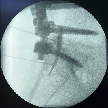 infiltracion lumbar - bloqueo selectivo- lumbalgia- procedimiento intervencionista- dr tafur -neuro-neurocirugia- mejor neuro