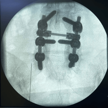infiltracion lumbar - bloqueo selectivo- lumbalgia- procedimiento intervencionista- dr tafur -neuro-neurocirugia- mejor neuro