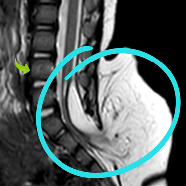 lipomeningocele, medula anclada, xieugia lumbar, dr tafur -neuro-neurocirugia- mejor neurocirujano (1)