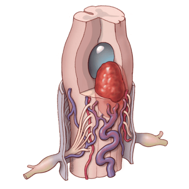 Malformación arteriovenasa cervical intramedular – hemorragia intramedular – dr david Tafur- neurocirujano en lima