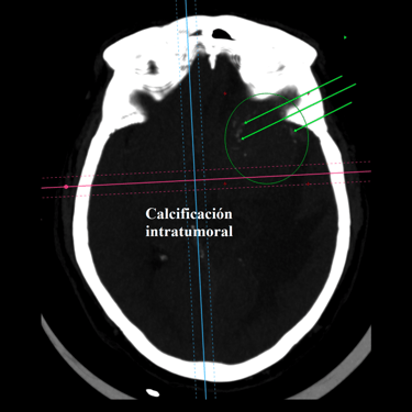 Meningioma - Tumor cerebral benigno - Craneotomia - microcirugia cerebral - dr david tafur - neurocirujano en lima (5)