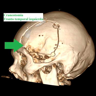 Meningioma - Tumor cerebral benigno - Craneotomia - microcirugia cerebral - dr david tafur - neurocirujano en lima (5)
