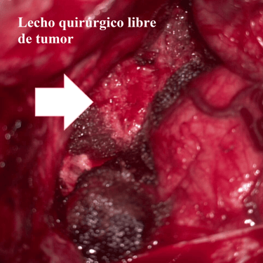 Meningioma - Tumor cerebral benigno - Craneotomia - microcirugia cerebral - dr david tafur - neurocirujano en lima (5)