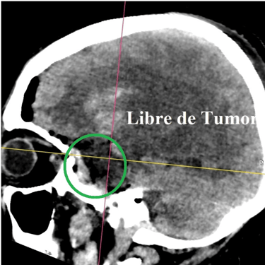 Meningioma - Tumor cerebral benigno - Craneotomia - microcirugia cerebral - dr david tafur - neurocirujano en lima (5)