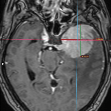 Meningioma - Tumor cerebral benigno - Craneotomia - microcirugia cerebral - dr david tafur - neurocirujano en lima (5)