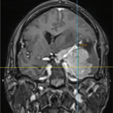 Meningioma - Tumor cerebral benigno - Craneotomia - microcirugia cerebral - dr david tafur - neurocirujano en lima (5)