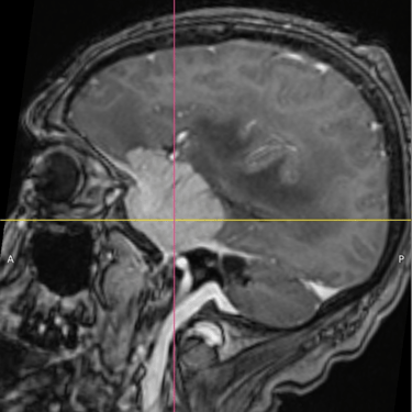 Meningioma - Tumor cerebral benigno - Craneotomia - microcirugia cerebral - dr david tafur - neurocirujano en lima (5)