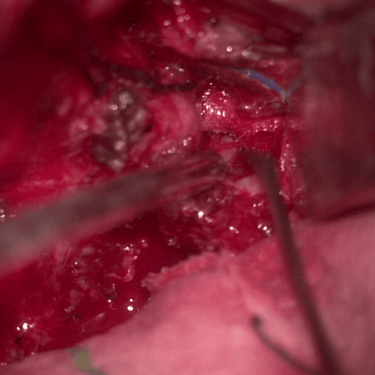 Meningioma - Tumor cerebral benigno - Craneotomia - microcirugia cerebral - dr david tafur - neurocirujano en lima (5)