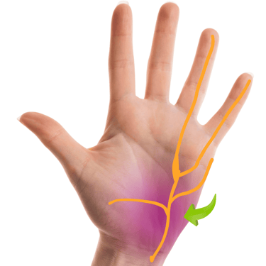 Sindrome de canal de guyon, cirugia de mano, nervios perifericos, dr tafur