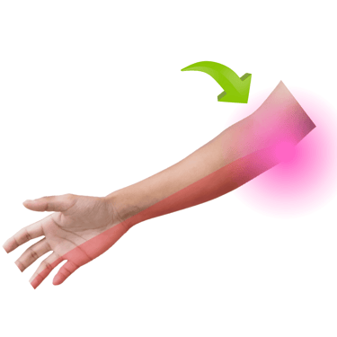 sindrome de tunel cubital, medico neurocirujano, dolor, nervio perifericos