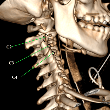 trauma vertebromedular-lesion cervical- cirugia cervical posterior-dr tafur -neuro-neurocirugia- mejor neurocirujano (26)