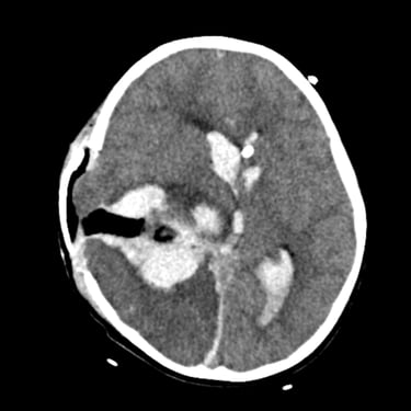 Tumor Cerebral Hemorrágico - Sarcoma - Complicación Hemorrágica - Dr. David Tafur - Neurocirujano en Lima