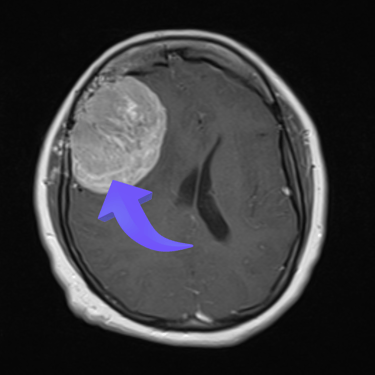 Tumor cerebral, meningioma cerebral, dr tafur, microcirugia, el mejor neurocirujano