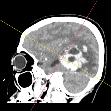 Tumor de ventriculo cerebral - meningioma cerebral - dr david tafur - neurocirujano en lima (1)
