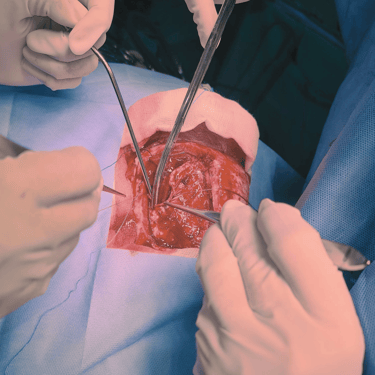 Hemorragia intracerebral por malformación arteriovenosa (AVM) – Craneotomía y evacuación de HIC – Dr. David Tafur – Neurociru