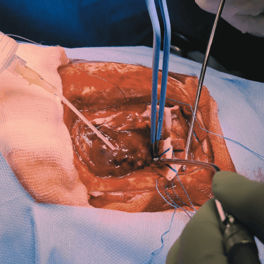 Hemorragia intracerebral por malformación arteriovenosa (AVM) – Craneotomía y evacuación de HIC – Dr. David Tafur – Neurociru