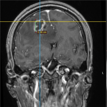 Tumor frontal intraaxial - Microcirugia - Dr david tafur - mejor neurocirujano (5)