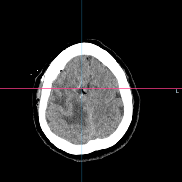 Tumor frontal intraaxial - Microcirugia - Dr david tafur - mejor neurocirujano (5)