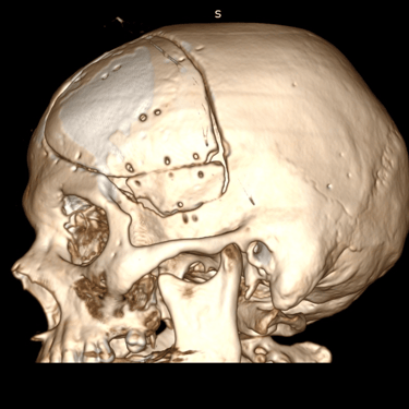 Tumor Fronto temporal izquierdo - Craneotomia - dr david tafur - neurocirujano en lima (3)