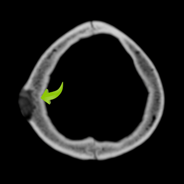 tumor oseo cranea, manejo de neurocirugia, dr tafur
