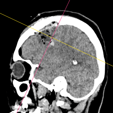 Tumor quístico cerebral – Cirugía neuroquirúrgica Dr. David Tafur (20)