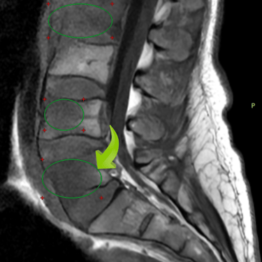 tumor vertebral, maligno, cirugia paliativa, dr tafur, cirujano de columna