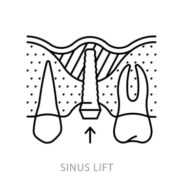 sinus lift