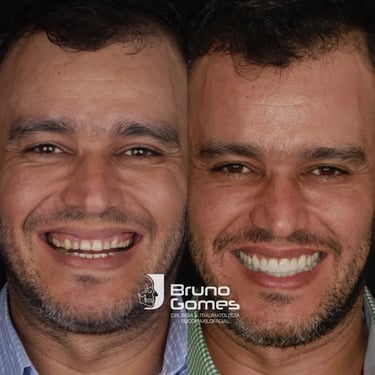 Antes e depois de cliente que fez o tratamento de Facetas dentais em barra do Garças