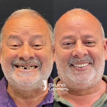 Tratamento de Implante dentário com carga rápida em Barra do Garças