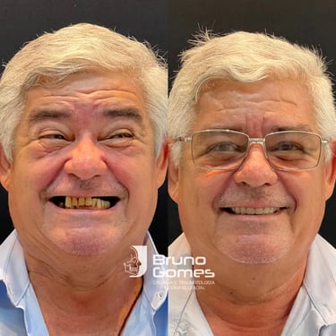 Tratamento de carga imediata com Prótese Protocolo Barra do Garças