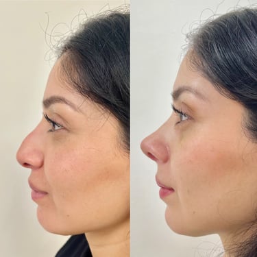 Perfil lateral de una mujer antes y después de una rinoplastia.