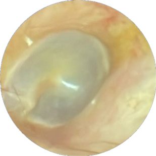 Video otoscope from patient ear canal view during ear microsuction at Waverley Pharmacy Aberdeen