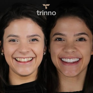 Resultado de antes e depois para o tratamento de facetas dentais.