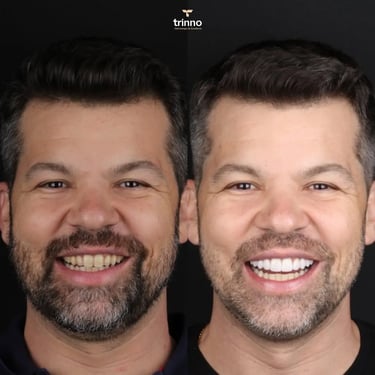 Resultados de Lentes de contato dental na Trinno Odontologia e Implantes
