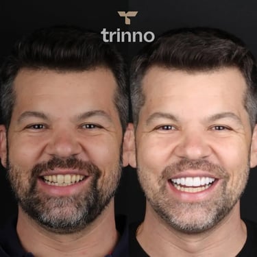 Resultados de Lentes de contato dental na Trinno Odontologia e Implantes