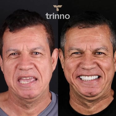 Resultado impressionante do cliente Trinno no tratamento de facetas dentais.