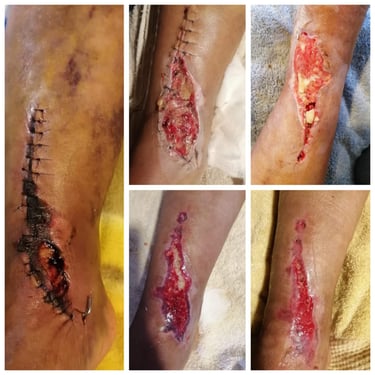 Una progresión de las etapas de cicatrización de heridas quirúrgicas y recuperación de úlceras.