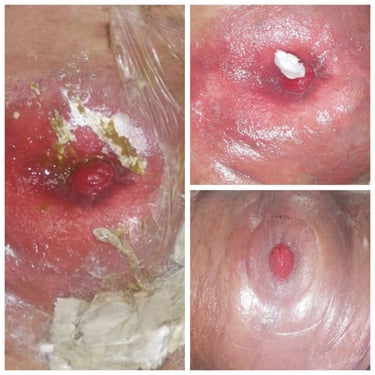 colostomia ileostomia estomas curacion educacion estomas