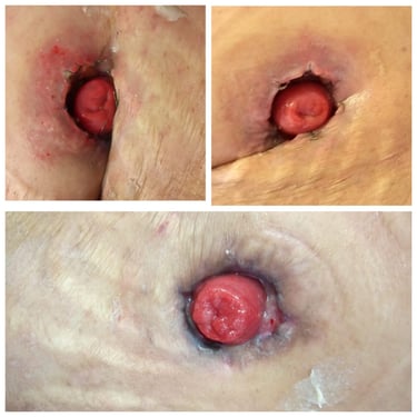 colostomía ileostomía estoma de eliminacion complicación quirúrgica