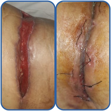 Herida quirurgica cerrada con terapia avanzada de heridas