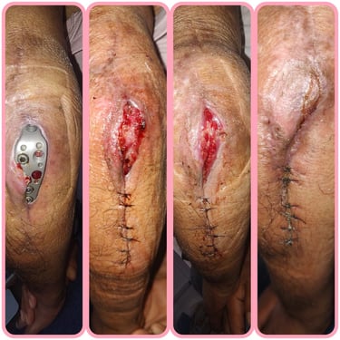 dehiscencia de herida quirurgica curacion de heridas cicatrizacion