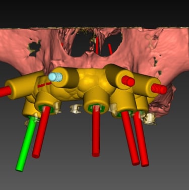 Planificación digital tridimensional para implantes dentales basada en anatomía ósea del paciente