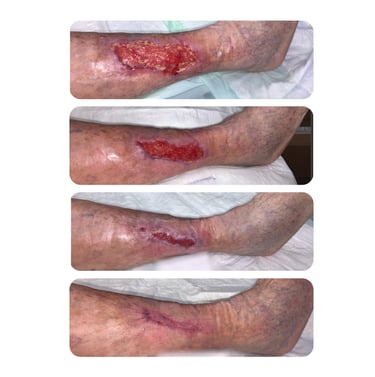 Abheilung eines Ulcus cruris