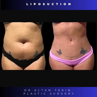 liposuction before after photos
